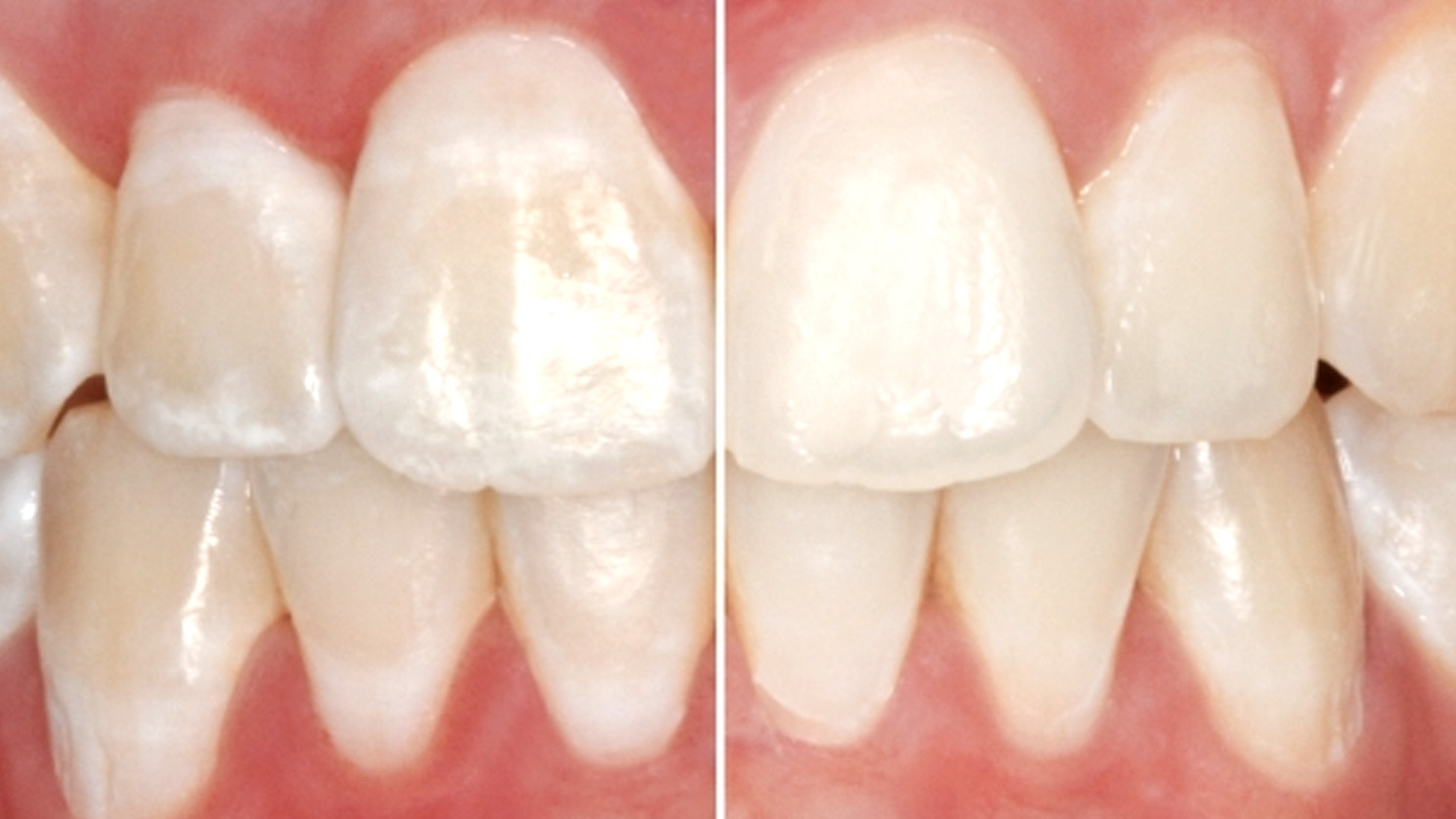 image demonstrates white spots that occur from braces on teeth